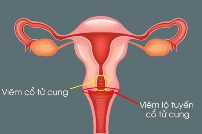 Viêm lộ tuyến tử cung là nguyên nhân khiến nữ giới bị vô sinh, hiếm muộn