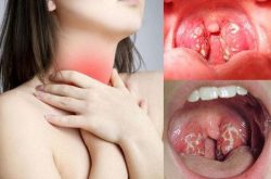 Viêm amidan là tình trạng các amidan trong cổ họng bị sưng và viêm