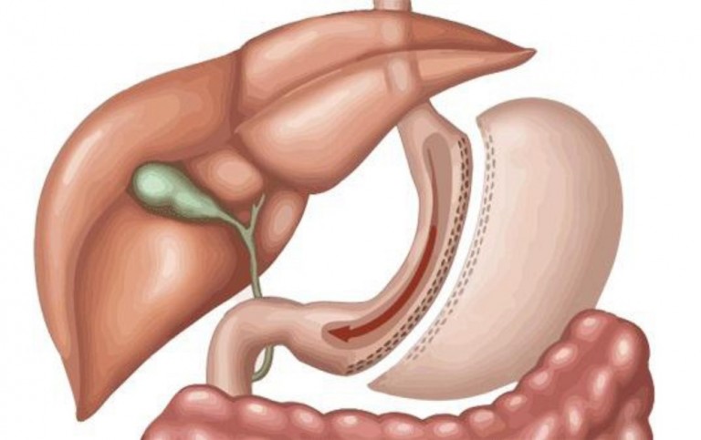Người bệnh bị mắc biến chứng viêm loét dạ dày có thể phải phẫu thuật cắt bỏ một phần dạ dày