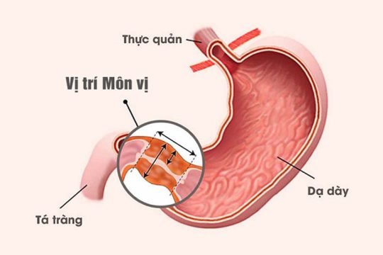 TS, Bác sĩ Nguyễn Thị Vân Anh cảnh báo biến chứng bệnh viêm loét dạ dày